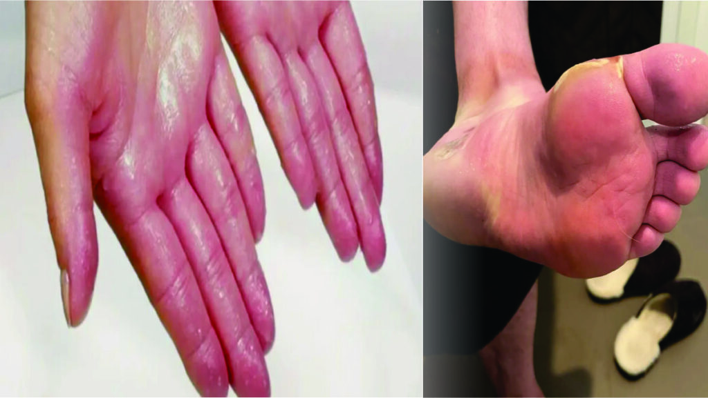 hyperhidrosis best treatment for hands and foot in hindi