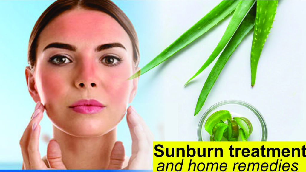 Sunburn treatment