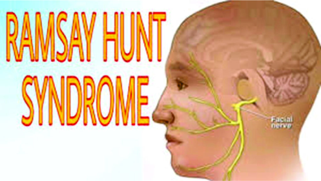 Ramsay Hunt syndrome Symptoms and causes