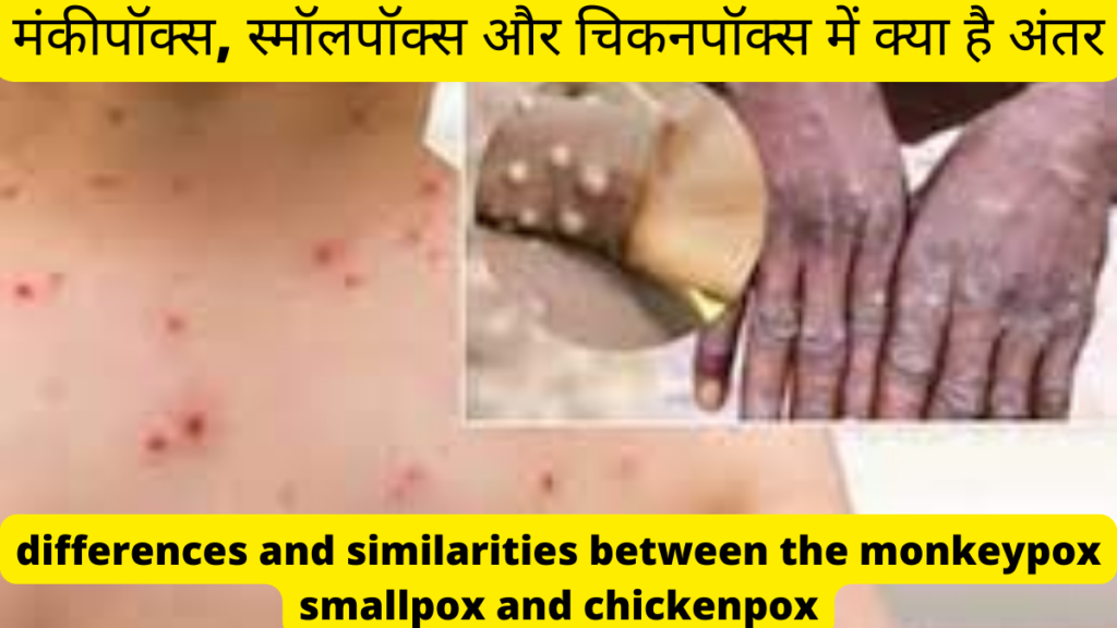 Monkeypox smallpox and chickenpox