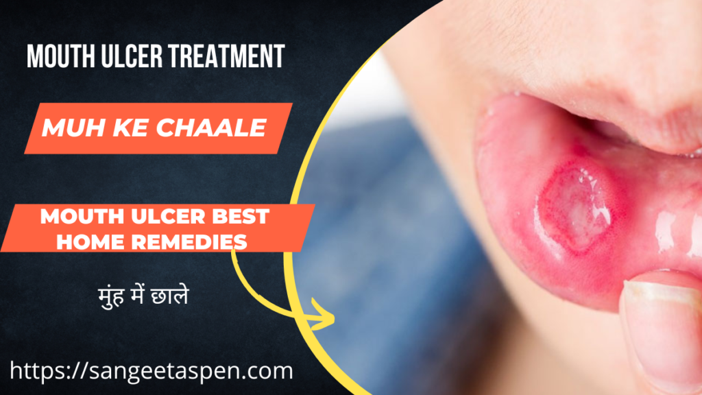 Mouth Ulcer Best Home Remedies