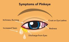Conjunctivitis | pink eye | conjunctivitis eye | eye flu | eye flu symptoms signs causes treatment